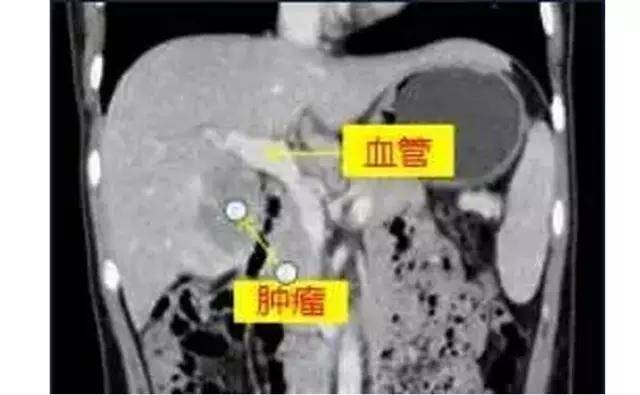 深圳26岁女孩入职体检发现肝癌晚期