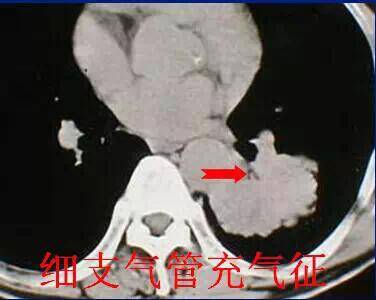 肺癌-细支气管充气征.jpg
