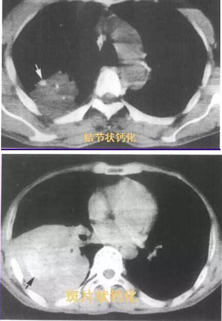 肺癌-钙化.jpg