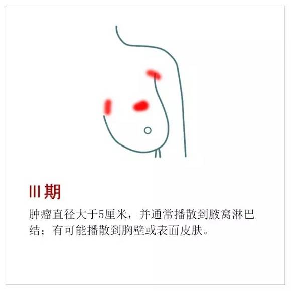 乳腺癌的分期,用图一目了然