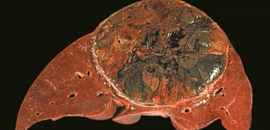 肝癌转移,复发,手术不能解决的怎么办?-肝癌康复圈--觅健