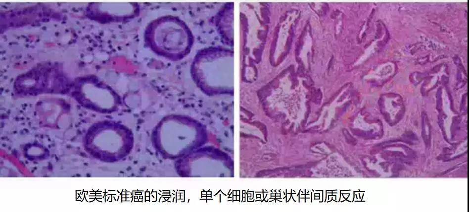 胃癌病理基础知识大盘点