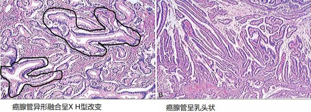 胃癌病理基础知识大盘点