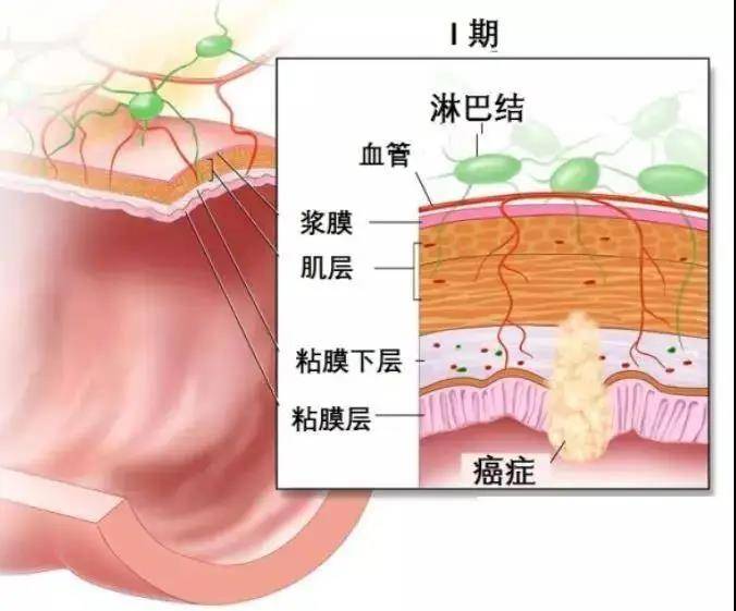 李心翔教授手把手教你解析腸癌術後病理報告