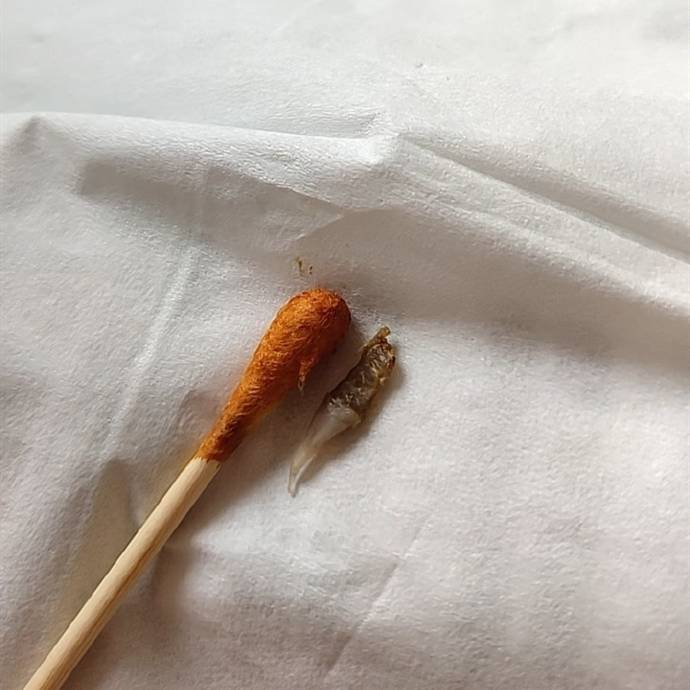 拔了picc管洞洞里有一块黑乎乎硬硬的东西