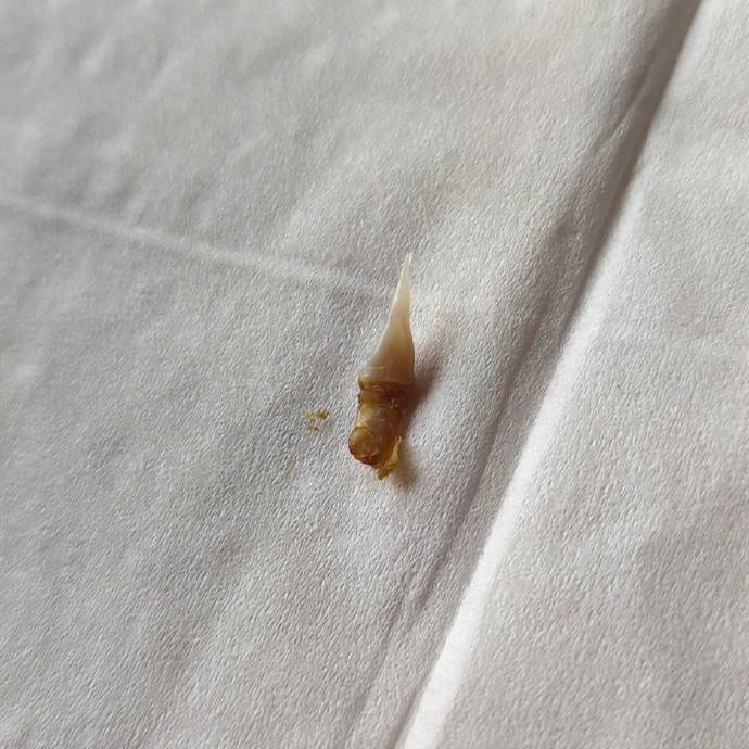 拔了picc管洞洞里有一块黑乎乎硬硬的东西