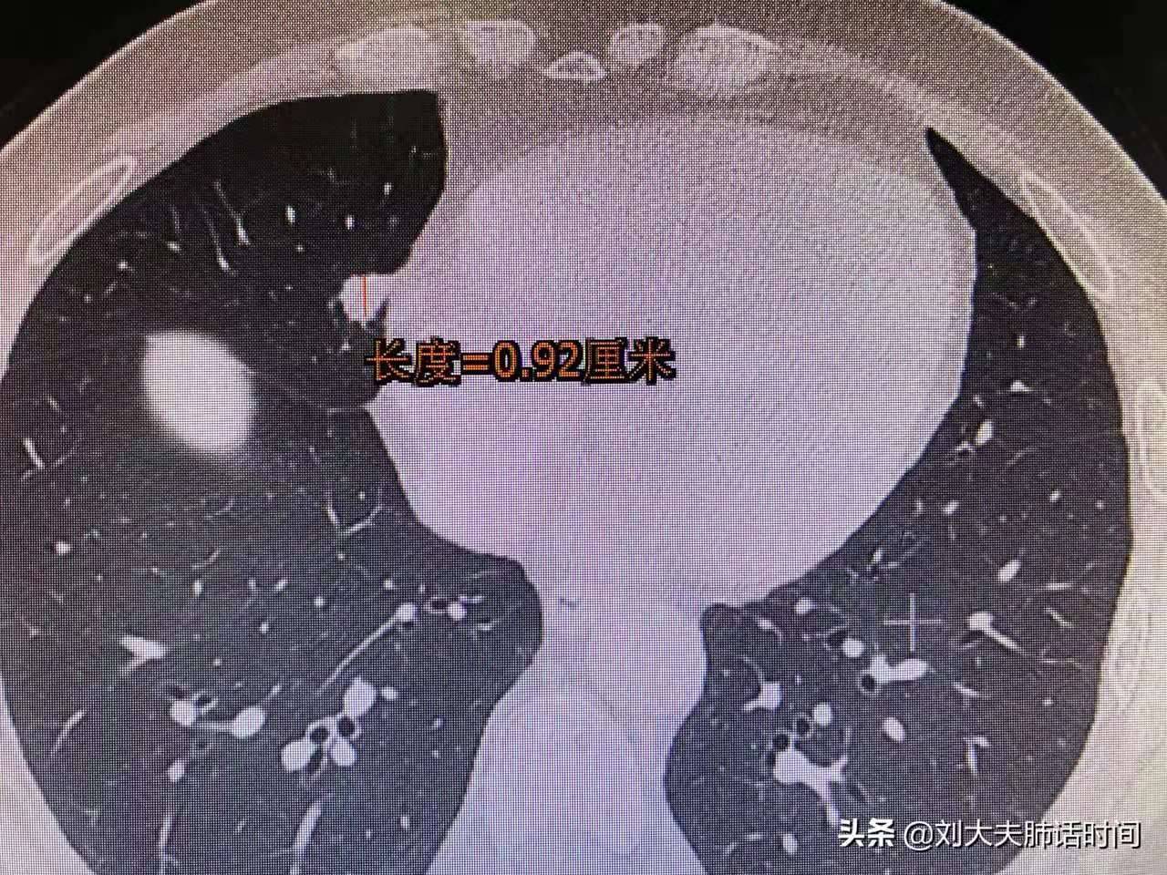 怎么知道肺结节是良性还是恶性的?