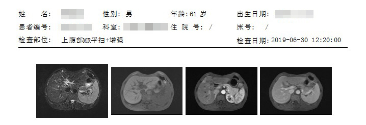 甲胎蛋白怎么检查图片