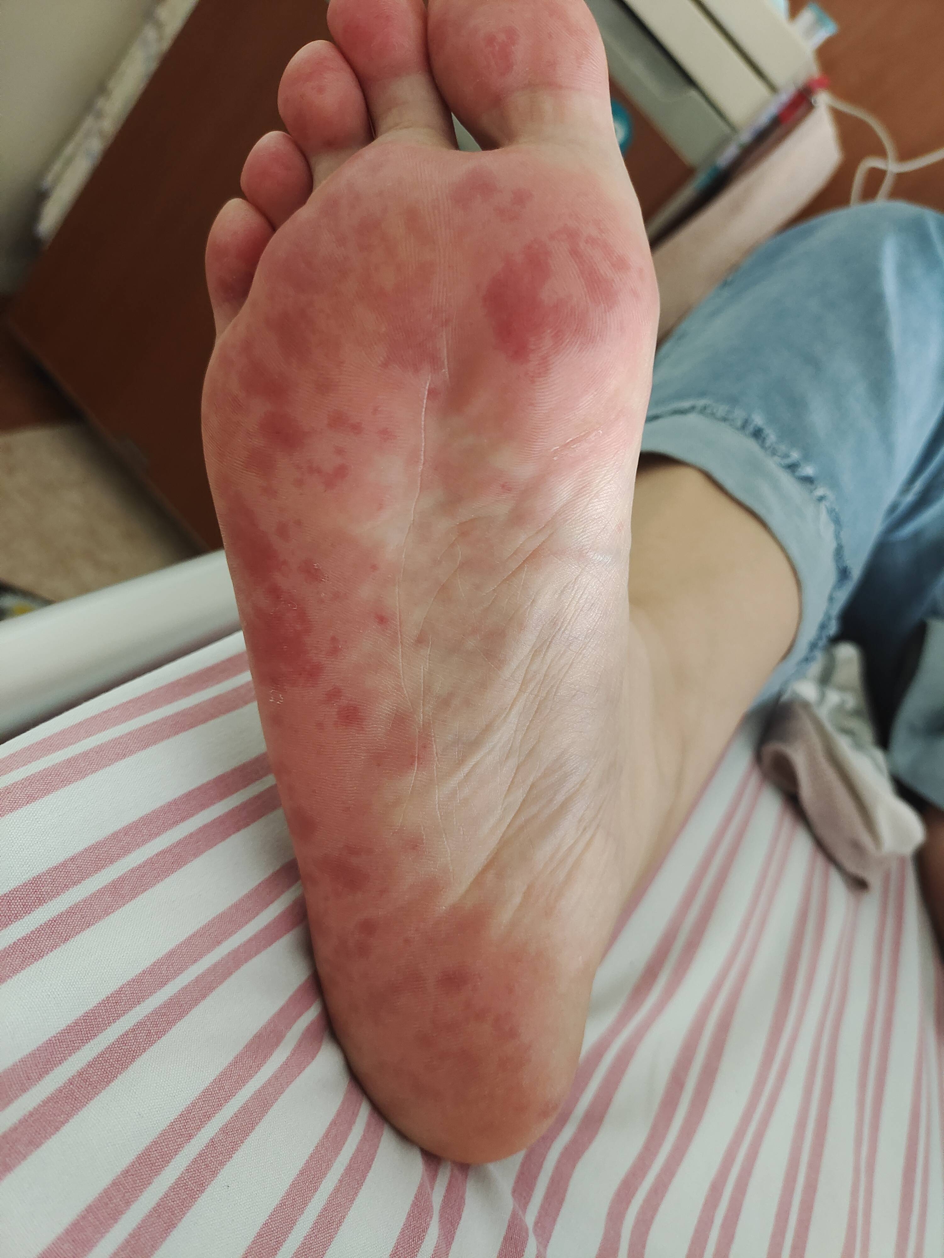 脚上有红斑是什么原因图片