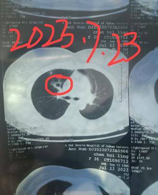 肺腺3a期,alk突变。确诊时右上肺肿块,右下肺小结节,纵隔2R4R区淋