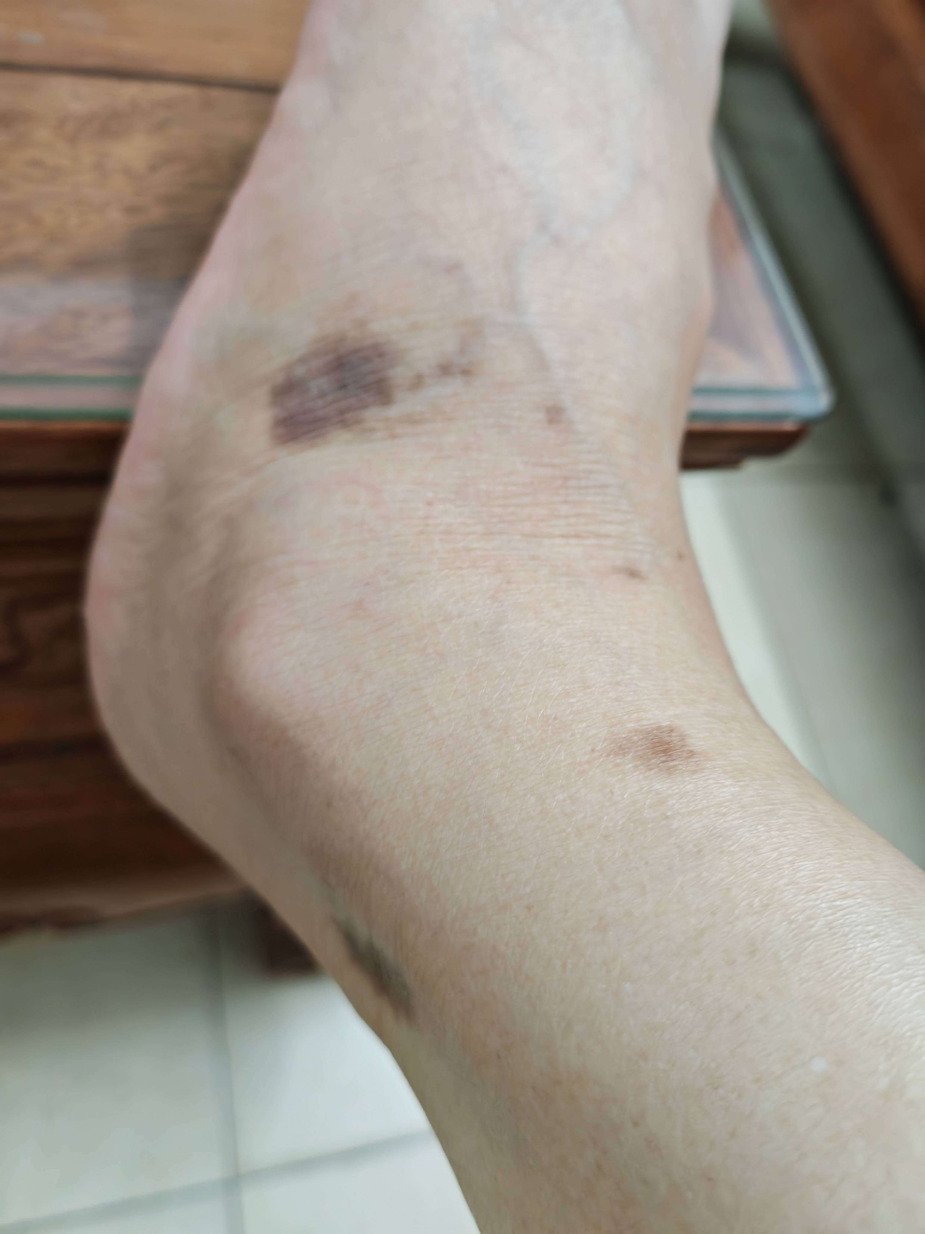 友友们好！我左脚上莫名长了几个大黑斑，好难看，这是什么情况？