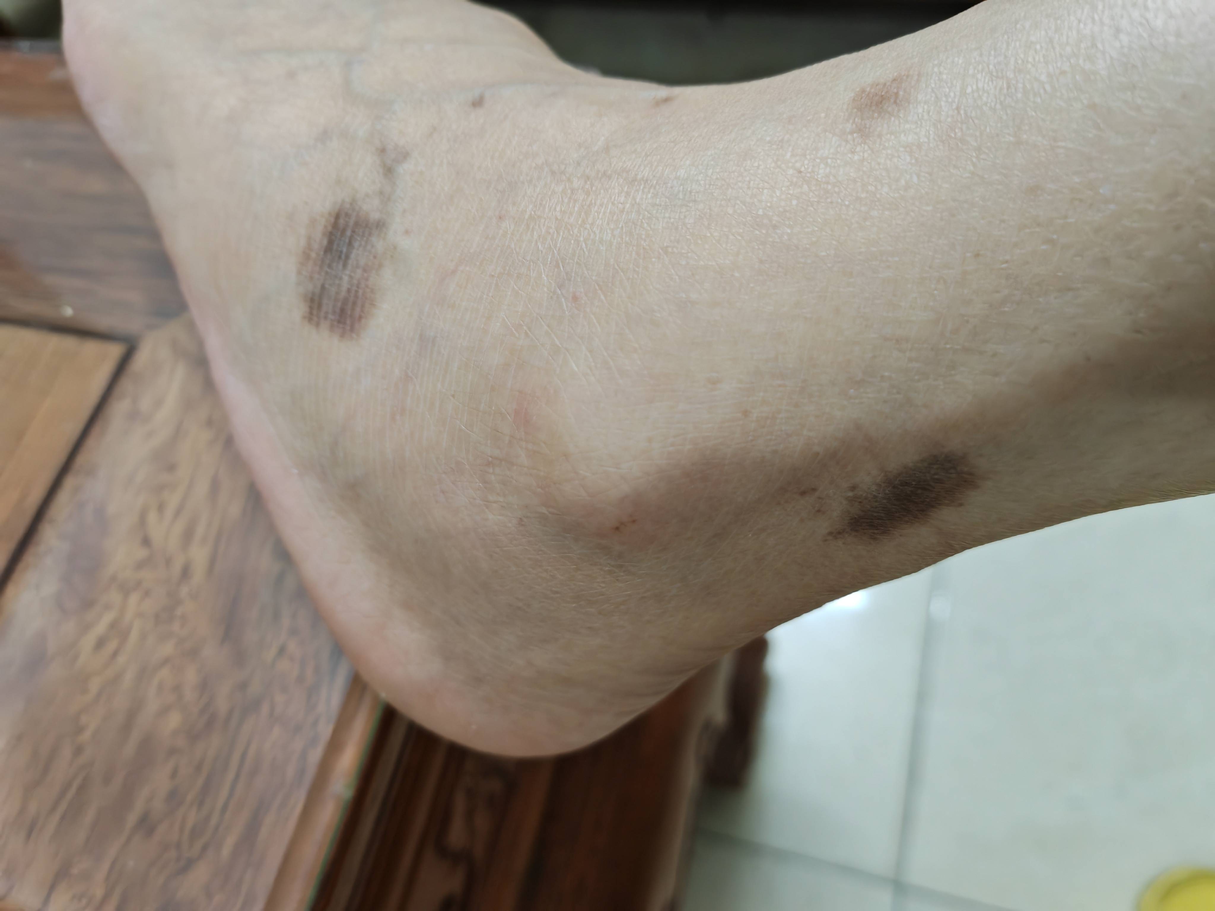 友友们好！我左脚上莫名长了几个大黑斑，好难看，这是什么情况？