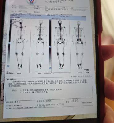 我母亲2022年九月手术，两阳一阴分型，上个月做骨扫描发现肋骨有点异常，